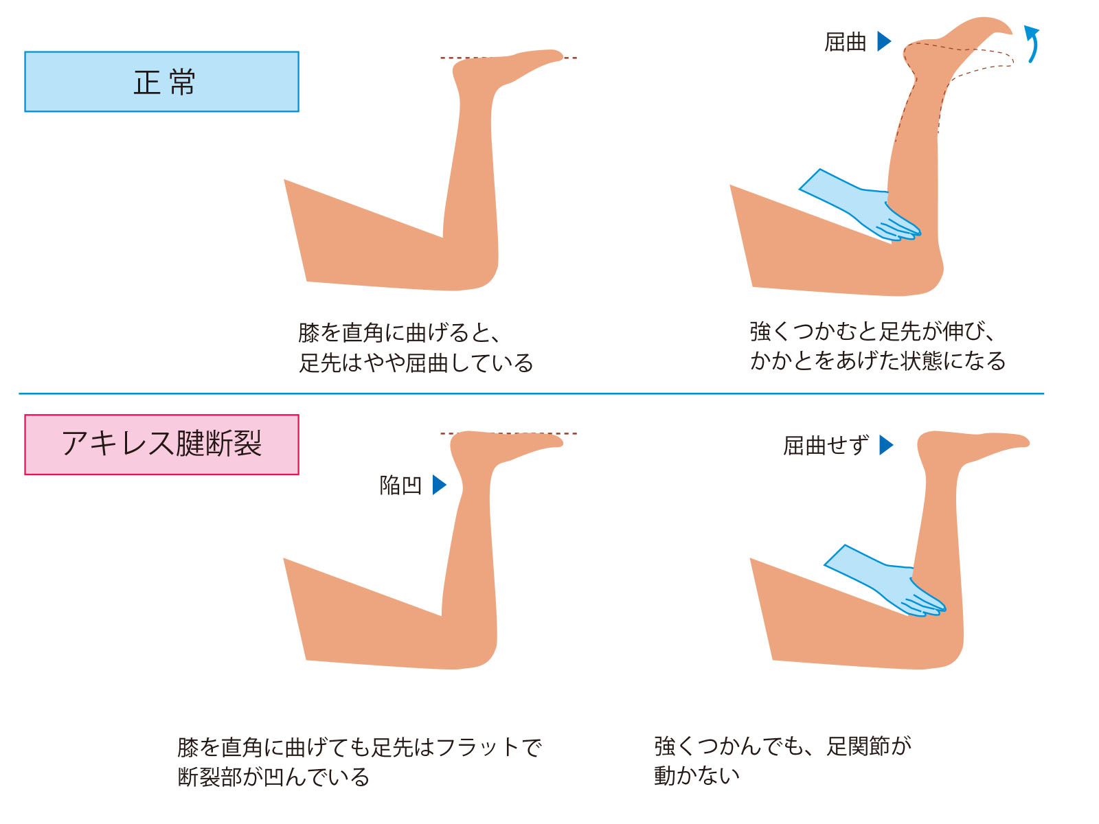 アキレス腱断裂とは｜症状と予防 復帰までに時間がかかるやっかいなケガ｜ジャーナル（サポーター）｜ザムスト公式オンラインショップ【ZAMST  Online】