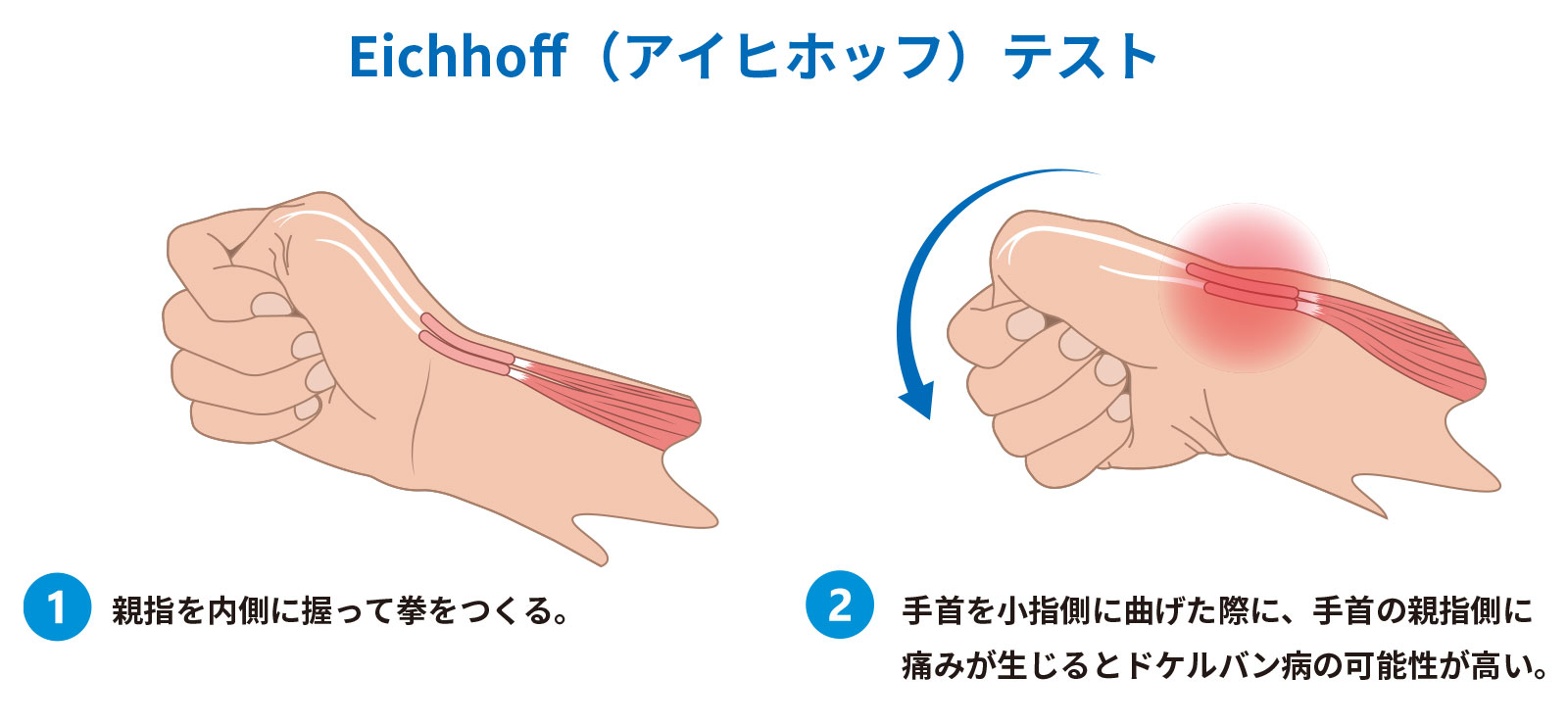 腱鞘炎・ドケルバン病｜手首の親指側の痛みを感じたら｜ジャーナル（サポーター）｜ザムスト公式オンラインショップ【ZAMST Online】