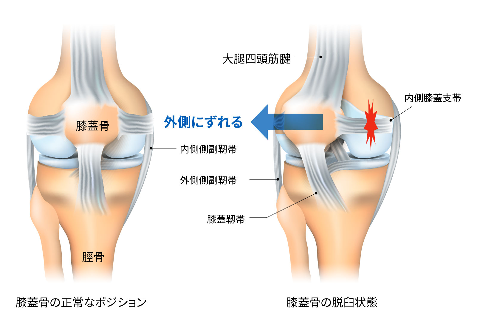 膝蓋骨脱臼とは｜思春期のスポーツ選手に起きやすい膝の怪我｜ジャーナル（サポーター）｜ザムスト公式オンラインショップ【ZAMST Online】